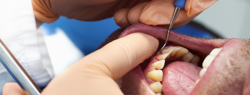 periodontitis málaga